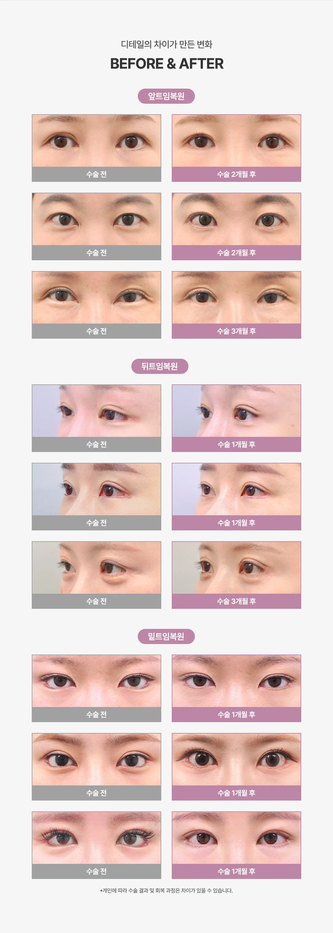 올로 트임복원 시술 안내